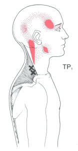 Trapezius Muscle Pain Illustration